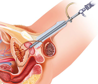papiloma urotelial tratamento